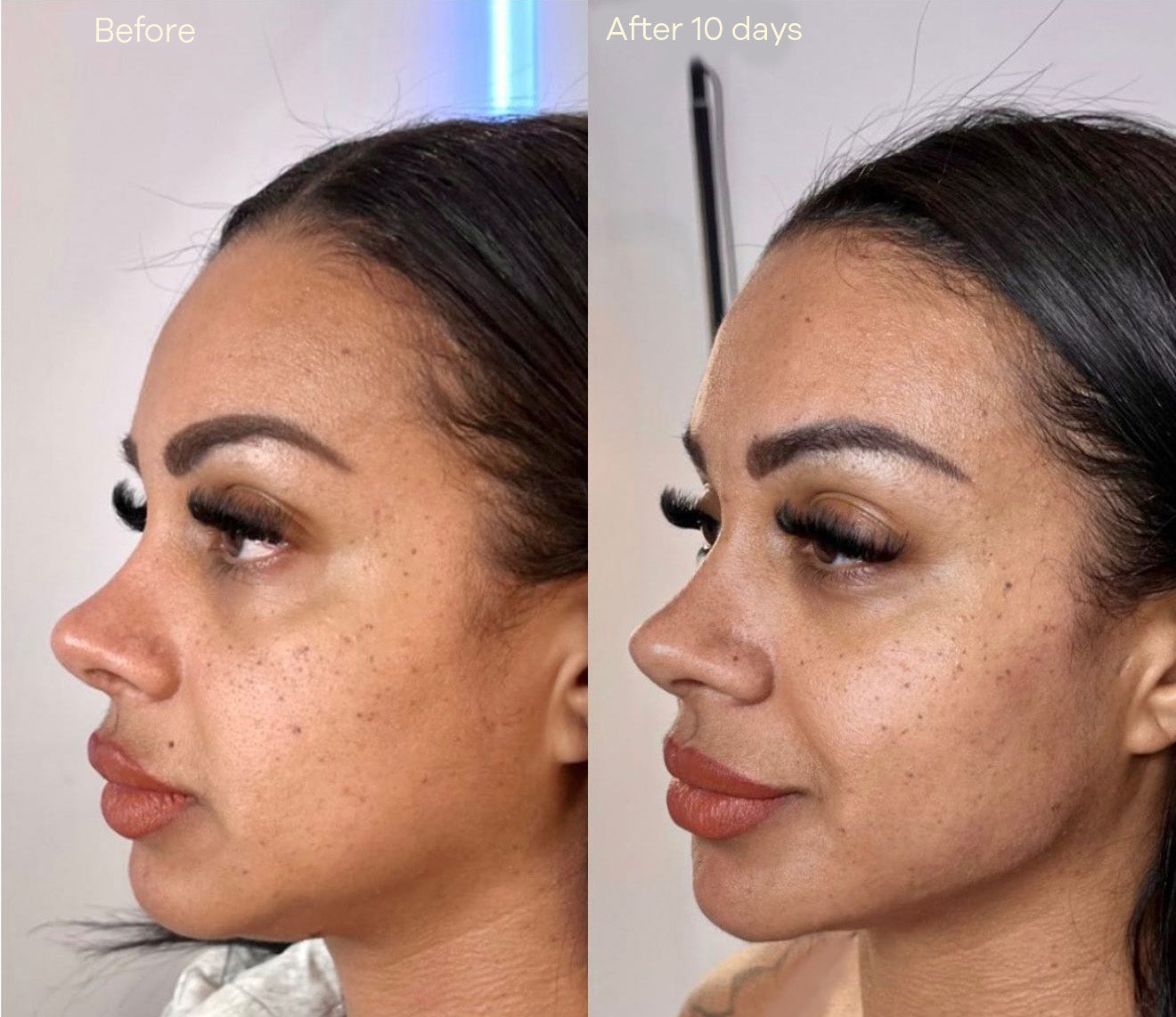 Lifty - Advanced Skin Lifting
